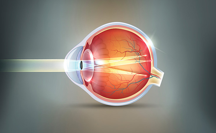 Astigmatism
